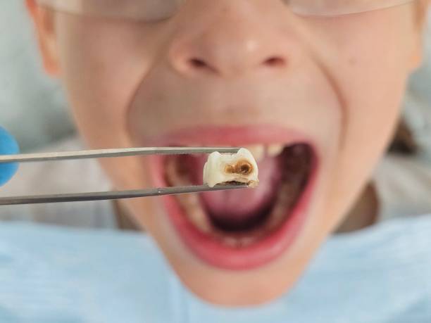 Best Same-Day Emergency Dental Services in Rossvle, IL