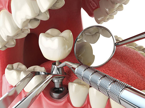 Best Emergency Treatment for Dental Infections or Abscesses in Rossvle, IL