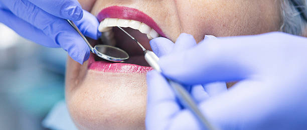 Best Emergency Root Canal Treatment in Rossvle, IL